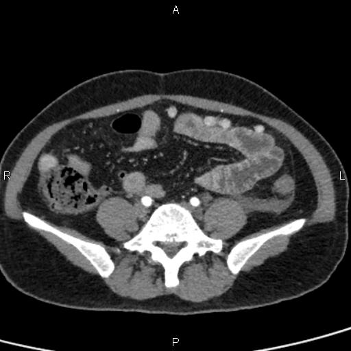 Bilateral adrenal gland hyperenhancement in pancreatitis (Radiopaedia 86642-102753 B 92).jpg