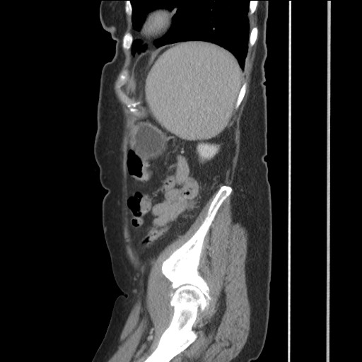 Bilateral adrenal granulocytic sarcomas (chloromas) (Radiopaedia 78375-91007 C 110).jpg