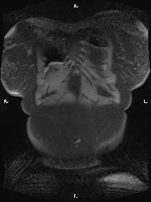 File:Bilateral adrenal myelolipoma (Radiopaedia 63058-71537 Coronal T1 fat sat 100).jpg