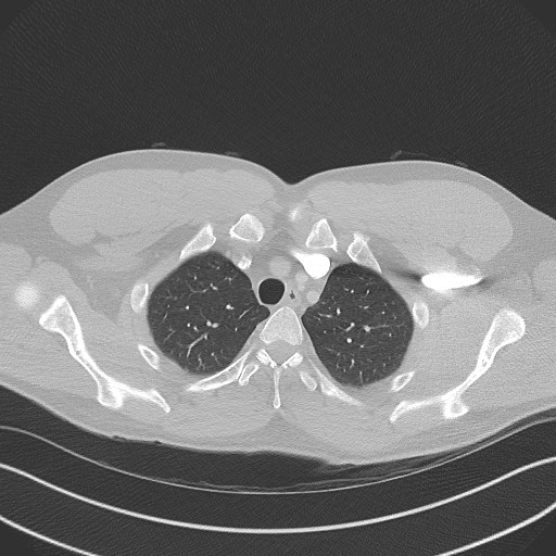 Bilateral atelectasis (Radiopaedia 48666-53675 Axial lung window 17).jpg