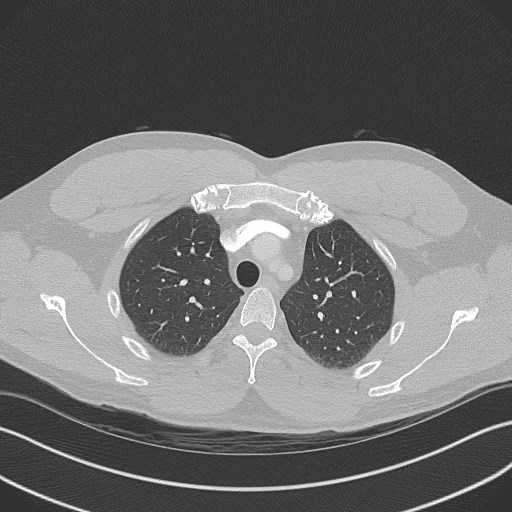 File:Bilateral atelectasis (Radiopaedia 48666-53675 Axial lung window 25).jpg