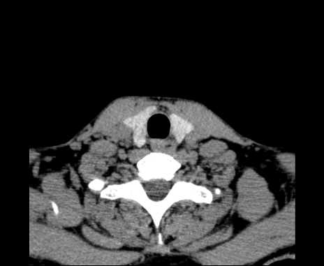Bilateral carotid body tumors (Radiopaedia 61841-69870 Axial non-contrast 93).jpg