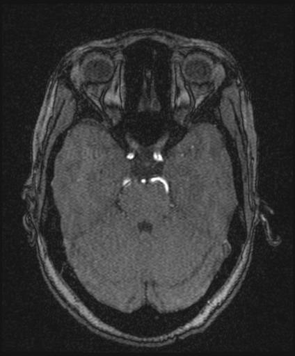 Bilateral carotid body tumors and right glomus jugulare tumor (Radiopaedia 20024-20060 Axial MRA 63).jpg