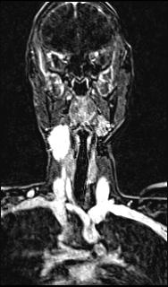 File:Bilateral carotid body tumors and right glomus jugulare tumor (Radiopaedia 20024-20060 MRA 87).jpg