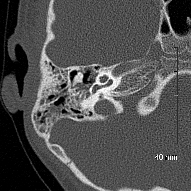 Bilateral grommets (Radiopaedia 47710-52404 Axial bone window 36).jpg