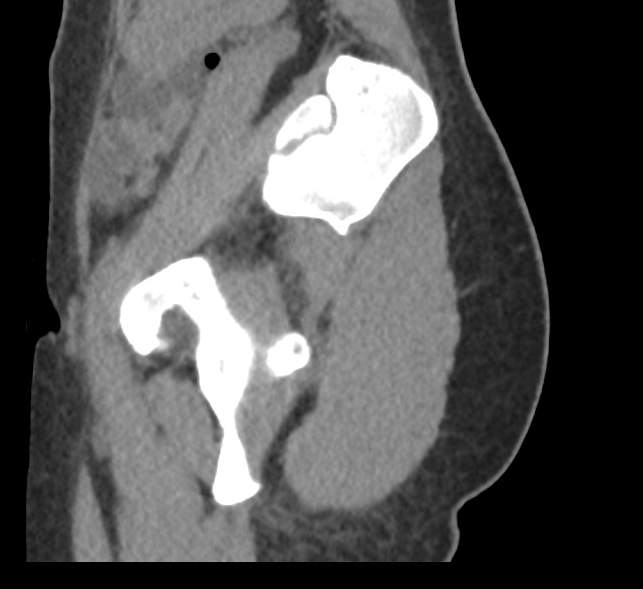 Bilateral mature cystic ovarian teratoma (Radiopaedia 88821-105592 D 61).jpg