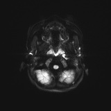 File:Bilateral mesial temporal polymicrogyria (Radiopaedia 76456-88181 Axial DWI 26).jpg