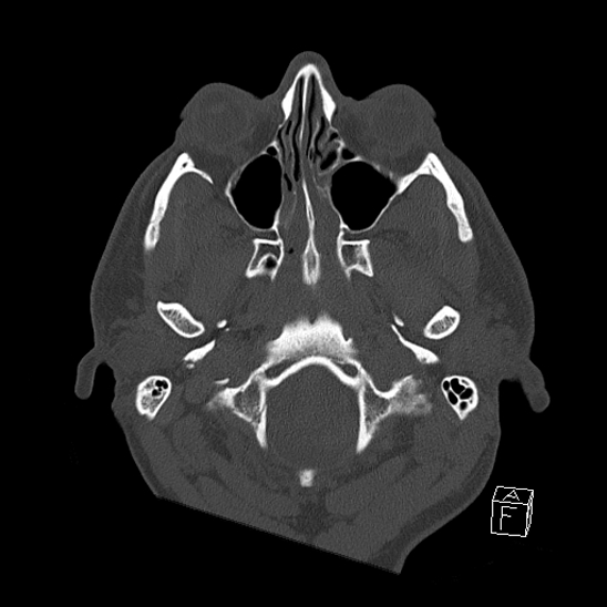 Bilateral occipital condyle fracture (type 2) (Radiopaedia 87675-104089 Axial bone window 13).jpg