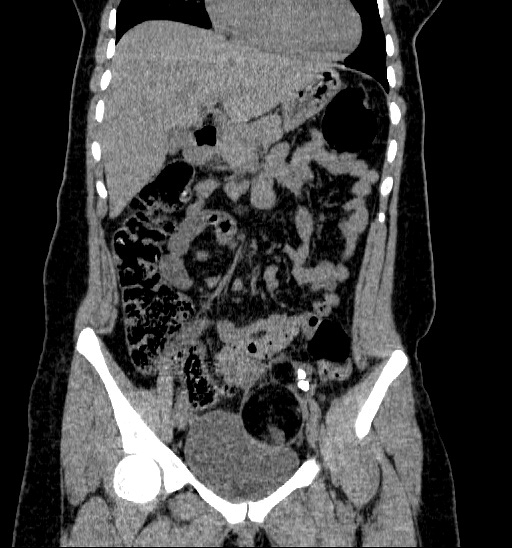 File:Bilateral ovarian dermoid (Radiopaedia 45714-49907 Coronal non-contrast 1).jpg