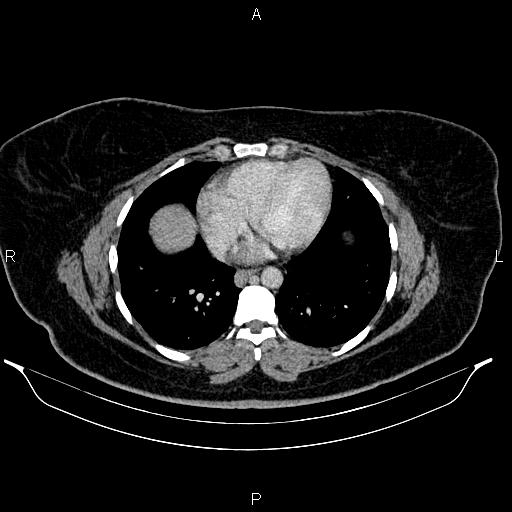 Bilateral ovarian dermoid cysts (Radiopaedia 85785-101603 A 8).jpg