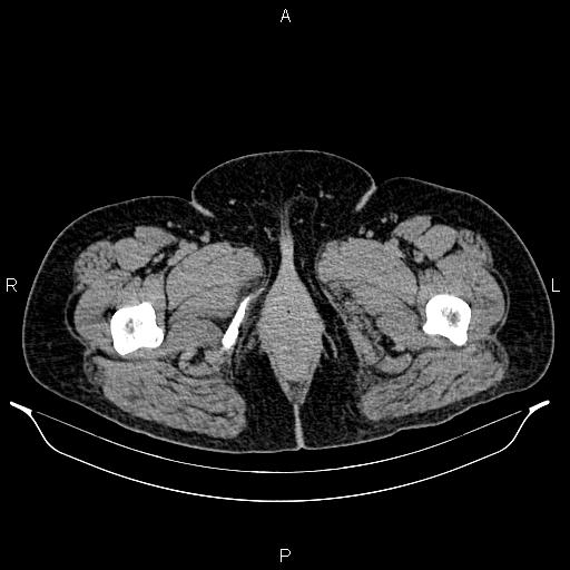 Bilateral ovarian dermoid cysts (Radiopaedia 85785-101603 Axial C+ delayed 98).jpg