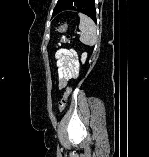 Bilateral ovarian dermoid cysts (Radiopaedia 85785-101603 D 79).jpg