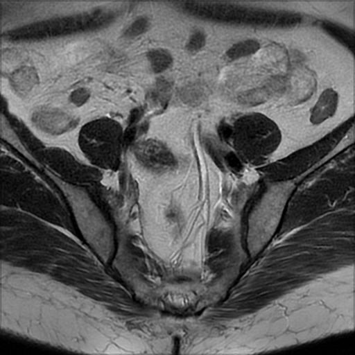 File:Bilateral ovarian dermoid cysts (Radiopaedia 90152-107338 Axial T2 5).jpg