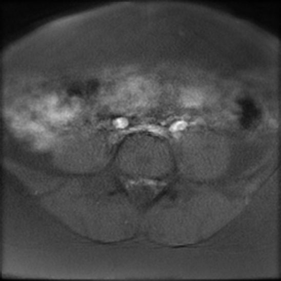 File:Bilateral ovarian fibrothecomas - adolescent (Radiopaedia 86604-102707 Axial T1 fat sat 2).jpg