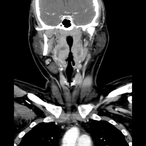 File:Bilateral peritonsillar abscess (Radiopaedia 85065-100610 Coronal 36).jpg