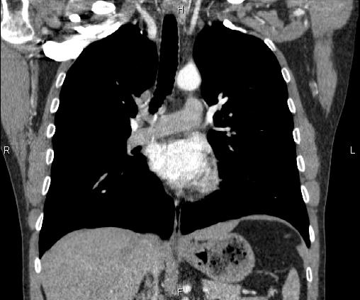 File:Bilateral pulmonary AVM (Radiopaedia 83134-97505 C 39).jpg