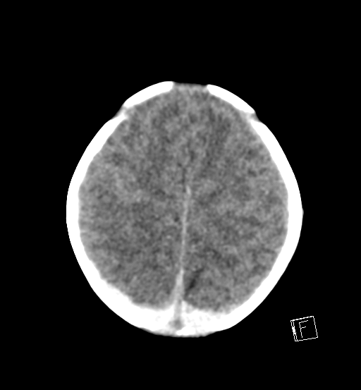 File:Bilateral subdural hemorrhage and parietal skull fracture (Radiopaedia 26058-26192 Axial non-contrast 6).png