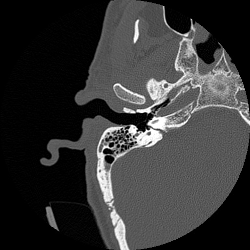 File:Bilateral temporal bone fractures (Radiopaedia 29482-29970 Axial non-contrast 7).jpg