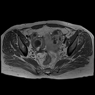 Bilateral tubo-ovarian abscesses (Radiopaedia 58635-65829 Axial T1 C+ 25).jpg