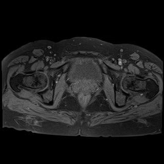 Bilateral tubo-ovarian abscesses (Radiopaedia 58635-65829 Axial T1 fat sat 37).jpg