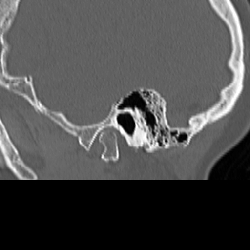 Bilateral tympanoplasty (Radiopaedia 16947-16664 Sagittal bone window 11).jpg