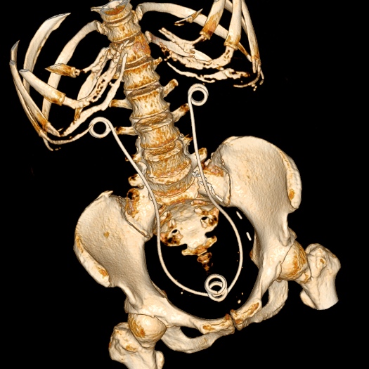 File:Bilateral ureteric stents (Radiopaedia 48795-53825 E 1).jpg