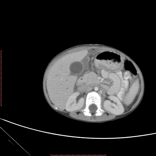 Biliary tract embryonal rhabdomyosarcoma (Radiopaedia 51815-57648 A 54).jpg