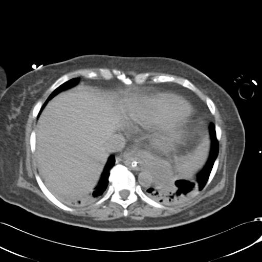 Bladder rupture post renal biopsy (Radiopaedia 30863-31572 Axial non-contrast 10).jpg