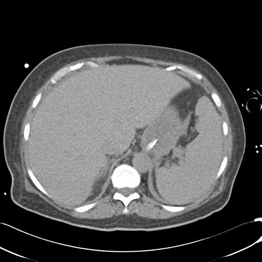 Bladder rupture post renal biopsy (Radiopaedia 30863-31572 Axial non-contrast 19).jpg