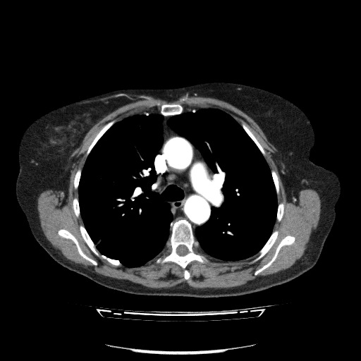 Bladder tumor detected on trauma CT (Radiopaedia 51809-57609 A 40).jpg