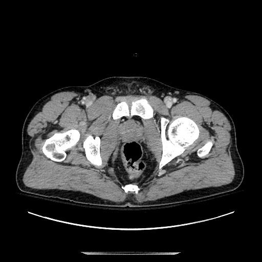 Blunt abdominal trauma with solid organ and musculoskelatal injury with active extravasation (Radiopaedia 68364-77895 A 154).jpg