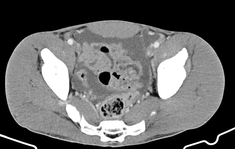 Blunt injury to the small bowel (Radiopaedia 74953-85987 A 167).jpg