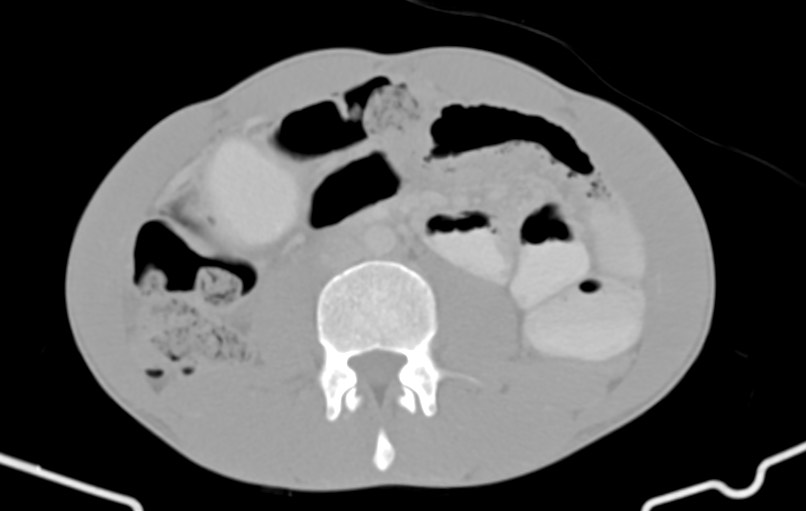 Blunt injury to the small bowel (Radiopaedia 74953-85987 Axial Wide 48).jpg