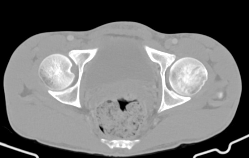 Blunt injury to the small bowel (Radiopaedia 74953-85987 Axial Wide 92).jpg