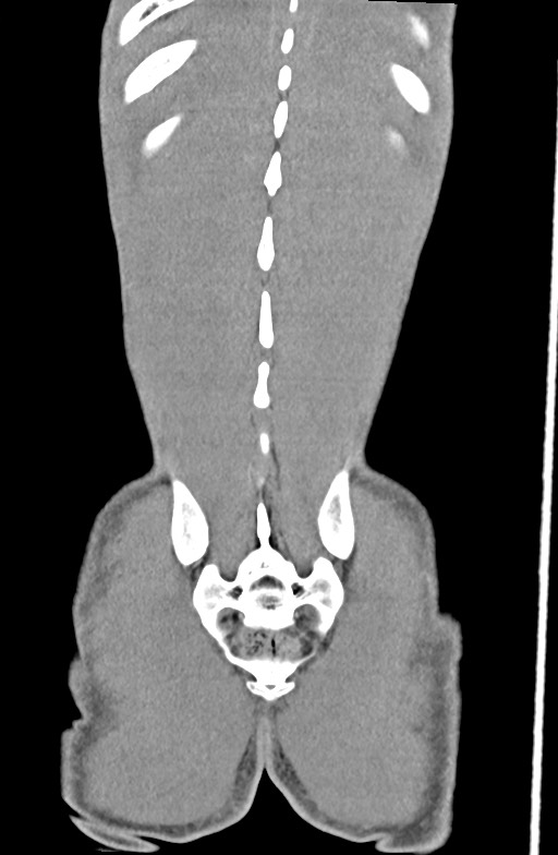 Blunt injury to the small bowel (Radiopaedia 74953-85987 B 87).jpg