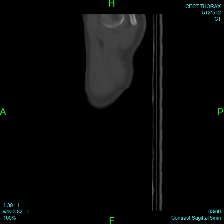 Bone metastases from lung carcinoma (Radiopaedia 54703-60937 Sagittal bone window 63).jpg