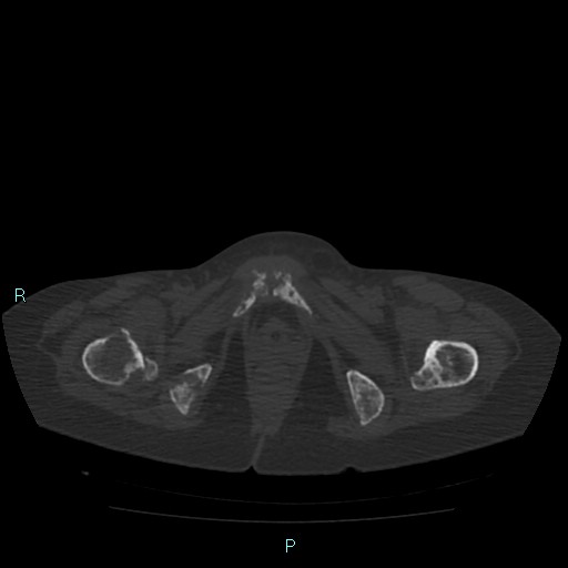 Bone metastases from untreated breast cancer (Radiopaedia 42973-46219 Axial bone window 199).jpg