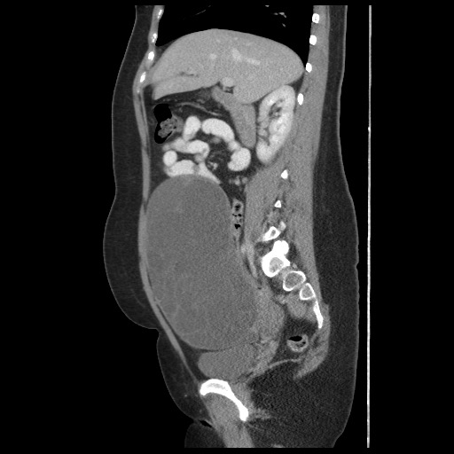 File:Borderline mucinous tumor (ovary) (Radiopaedia 78228-90808 B 28).jpg