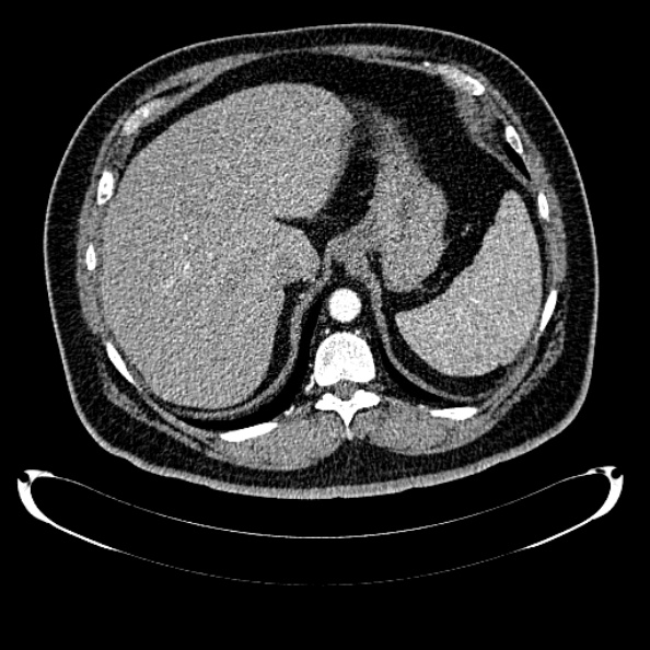 Bosniak renal cyst - type IV (Radiopaedia 24244-24518 B 56).jpg