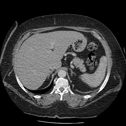 Bovine aortic arch - right internal mammary vein drains into the superior vena cava (Radiopaedia 63296-71875 A 169).jpg