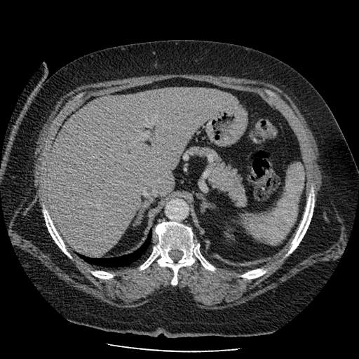 Bovine aortic arch - right internal mammary vein drains into the superior vena cava (Radiopaedia 63296-71875 A 171).jpg