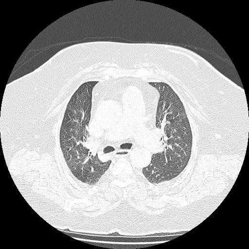 Bovine aortic arch - right internal mammary vein drains into the superior vena cava (Radiopaedia 63296-71875 Axial lung window 59).jpg