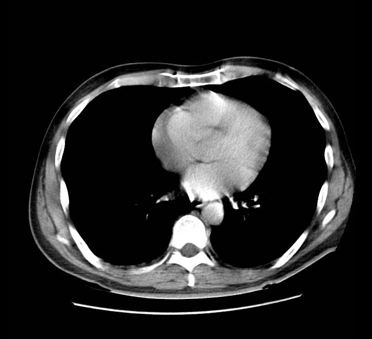 Bowel obstruction from colon carcinoma (Radiopaedia 22995-23028 A 1).jpg