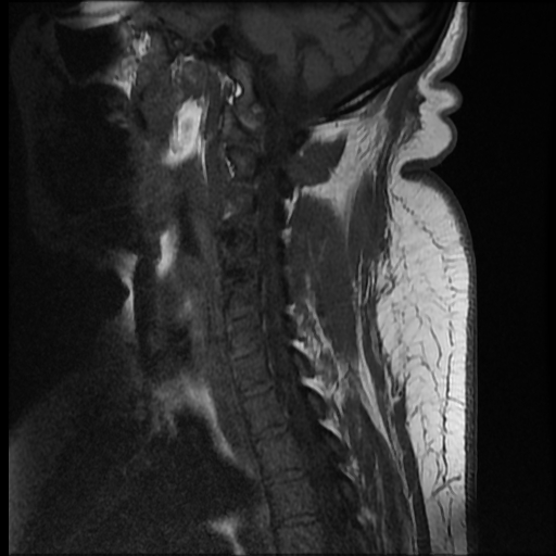 File:Brachial plexopathy (Radiopaedia 21844-21806 Sagittal T1 4).jpg