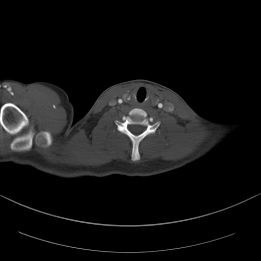 Brachiocephalic trunk pseudoaneurysm (Radiopaedia 70978-81191 Axial bone window 31).jpg