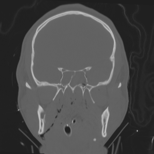 File:Brain contusions, internal carotid artery dissection and base of skull fracture (Radiopaedia 34089-35339 Coronal bone window 30).png