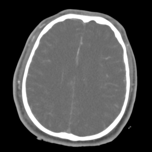 Brain contusions, internal carotid artery dissection and base of skull fracture (Radiopaedia 34089-35339 D 20).png
