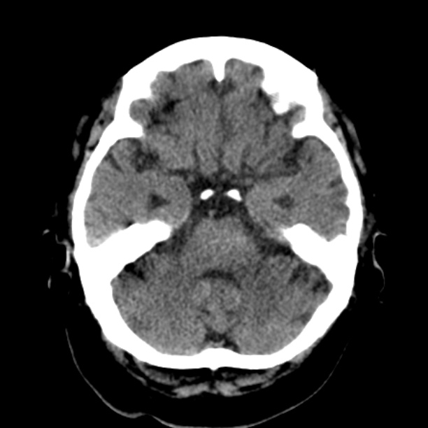 Brain cortical laminar necrosis (Radiopaedia 25822-25971 Axial non-contrast 12).jpg