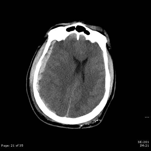 File:Brain death after motor vehicle collision (Radiopaedia 88470-105114 Axial non-contrast 21).jpg