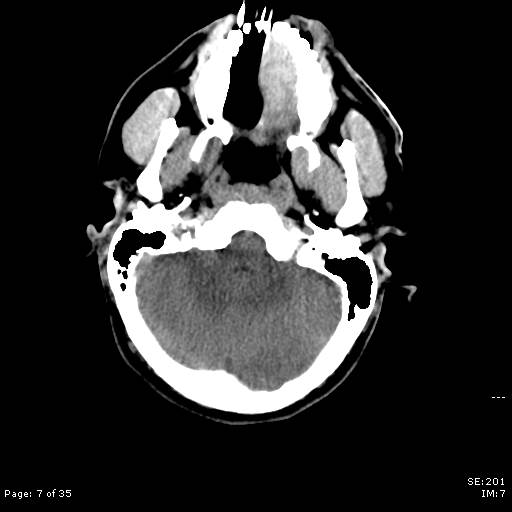 File:Brain death after motor vehicle collision (Radiopaedia 88470-105114 Axial non-contrast 7).jpg
